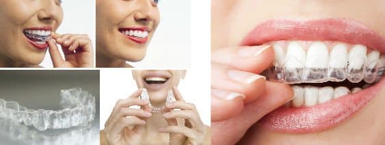 braces image