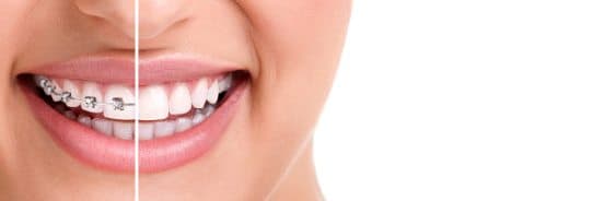 Invisalign Lite