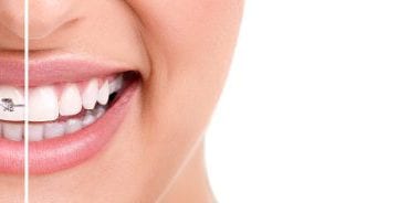 Invisalign Lite