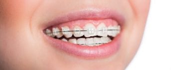 Orthodontic Treatment