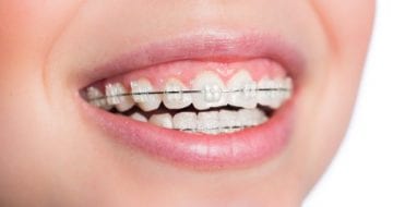 How to straighten teeth